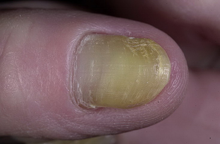Zespół żółtego paznokcia