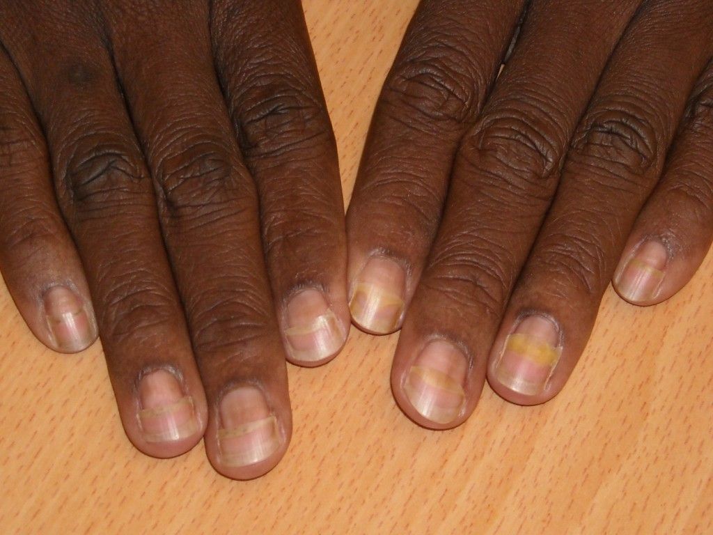 Złuszczenie płytki paznokciowej