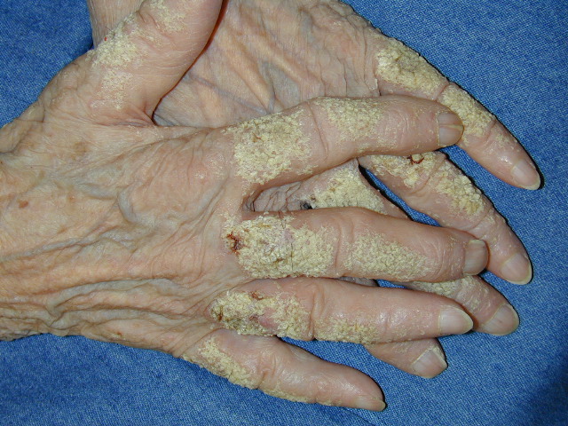 zmiany brodawkowate na powierzchniach grzbietowych rąk o cechach acrokeratosis verruciformis