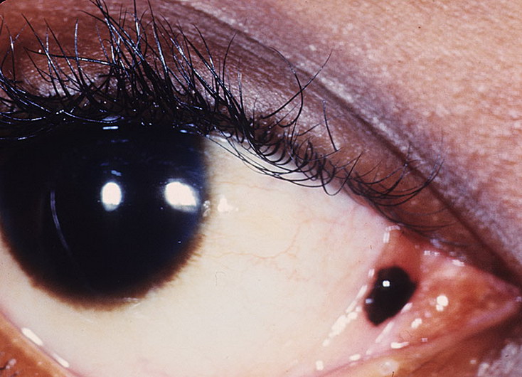 znamiona melanocytowe barwnikowe oko