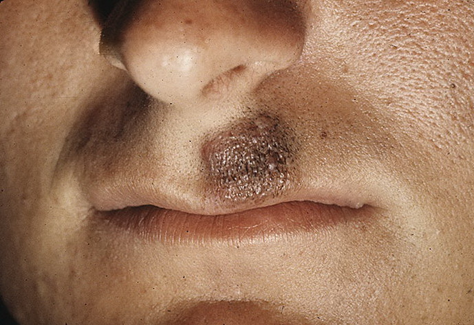 znamiona melanocytowe barwnikowe pod nosem wąsy