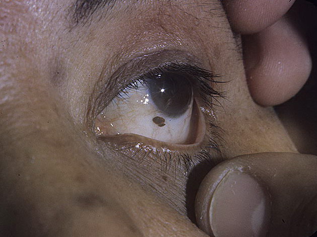 znamiona melanocytowe barwnikowe w oku
