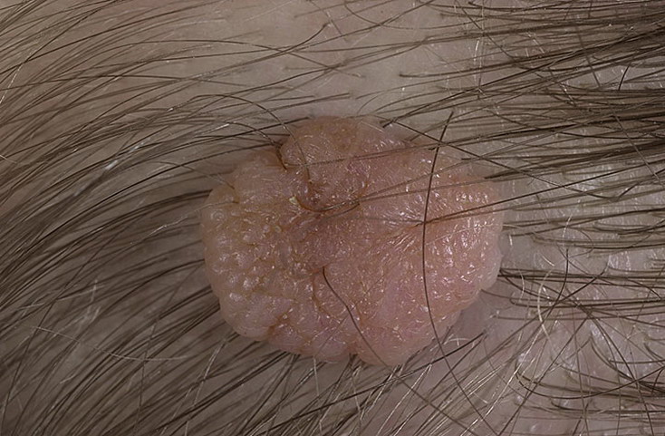 znamiona melanocytowe na skórze owłosionej