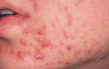 acne cystica