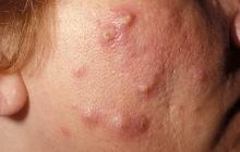  acne phlegmonosa