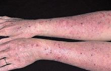 alergiczna choroba skóry