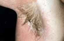 alergiczne choroby skóry pokrzywka