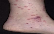alergiczne zapalenie naczyń krwionośnych na kostce