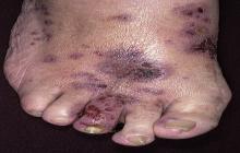 alergiczne zapalenie naczyń krwionośnych na stopie