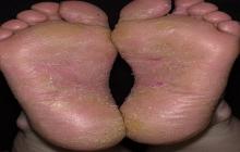 atopowe zapalenie skóry na stopach leczenie