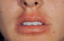 atopowe zapalenie skóry na ustach