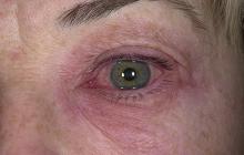 atopowe zapalenie skóry oka