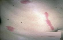 berloque dermatitis na brzuchu