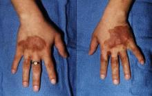 berloque dermatitis na dłoniach
