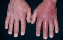 cellulitis dłoni