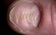 chore paznokcie u rąk