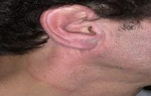 choroba grzybicza ucha