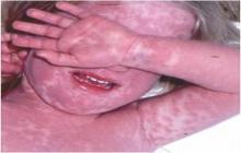 choroba kawasaki na całym ciele skóra