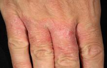 choroba skóry kontaktowe zapalenie skóry