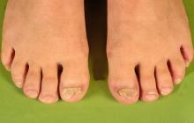 choroby paznokci u nóg