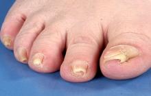 choroby paznokci u nóg zdjęcia