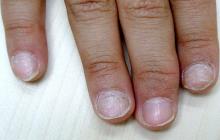 choroby paznokci jak wyglądają