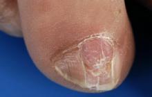 choroby płytki paznokciowej