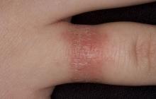 choroby skóry palców u rąk