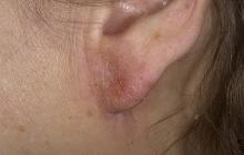 choroby skóry uszu