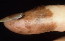 czerniak paznokcia obrazy