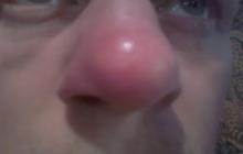 czerwony nos choroba
