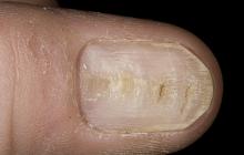 deformacja paznokcia
