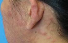 eozynofilia zapalenie mieszków włosowych na głowie