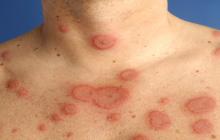 erythema multiforme pictures
