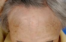 frontal fibrosing alopecia