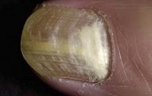 grzybica paznokci leki