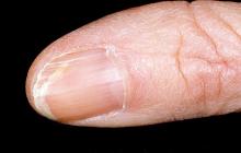 grzybica paznokci pierwsze stadium
