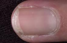 grzybica paznokci początkowe stadium
