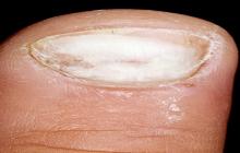 grzybica paznokcia palucha