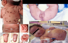 kiła syfilis wrodzony u dzieci zdjęcia