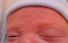 łojotokowe zapalenie skóry u niemowlaka