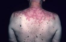 lupus choroba skóry