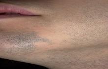 łysienie plackowate brody
