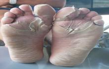 maceracja skóry na stopach