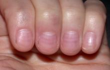 Muehrcke's nails