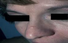 nerwiakowłókniak zdjęcia na nosie