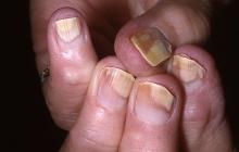 odwarstwianie paznokci palca
