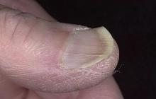 paznokcie łyżeczkowate (koilonychia)