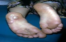 pęcherzowe oddzielanie się naskórka stóp nóg