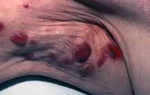 pemfigoid pęcherzowy objawy